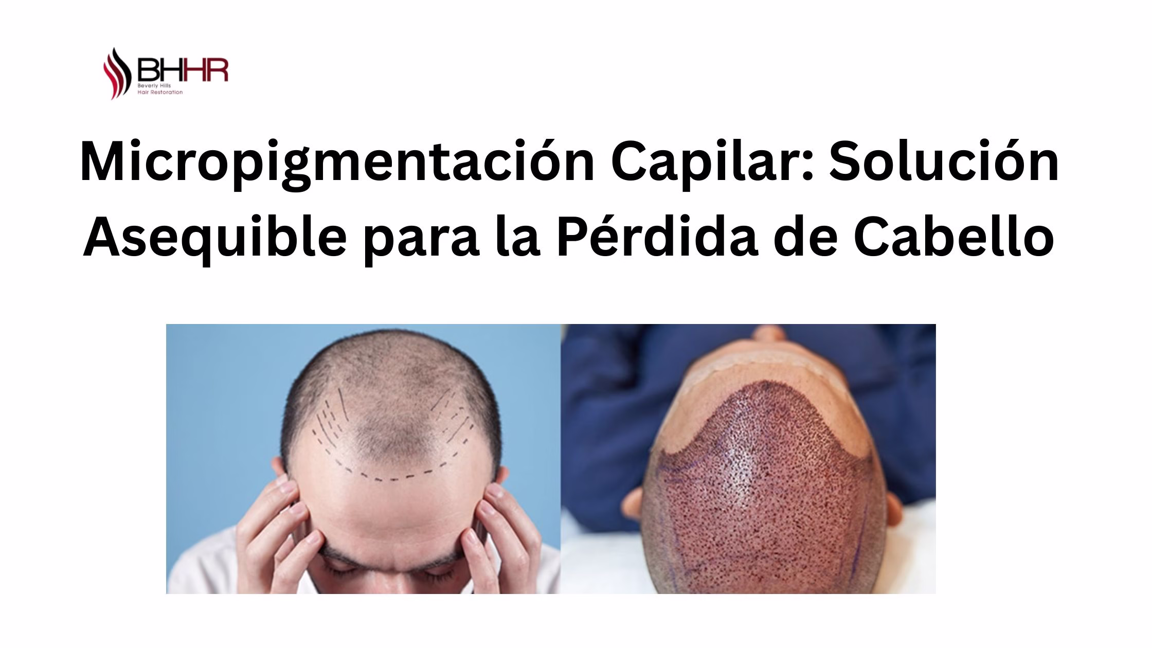 tratamiento de micropigmentacion capilar